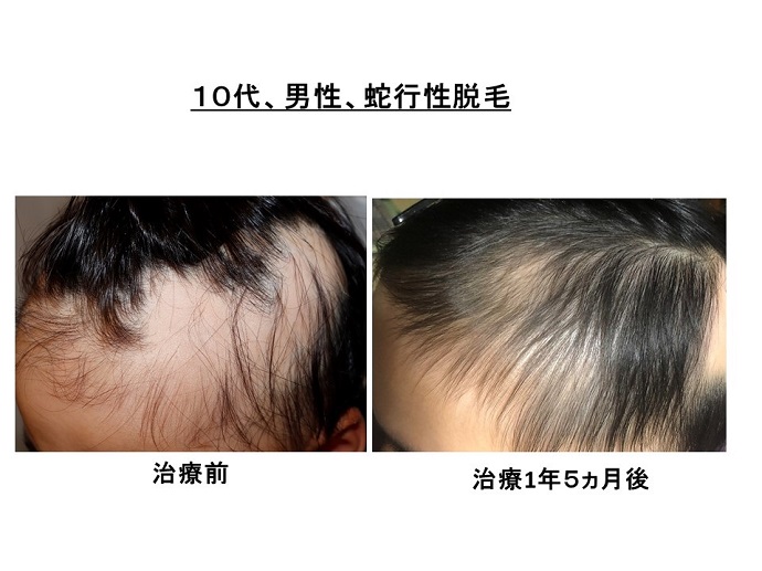 汎発性脱毛　病院